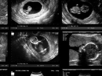 试管移植后都是怎么减药的以及减药的顺序？